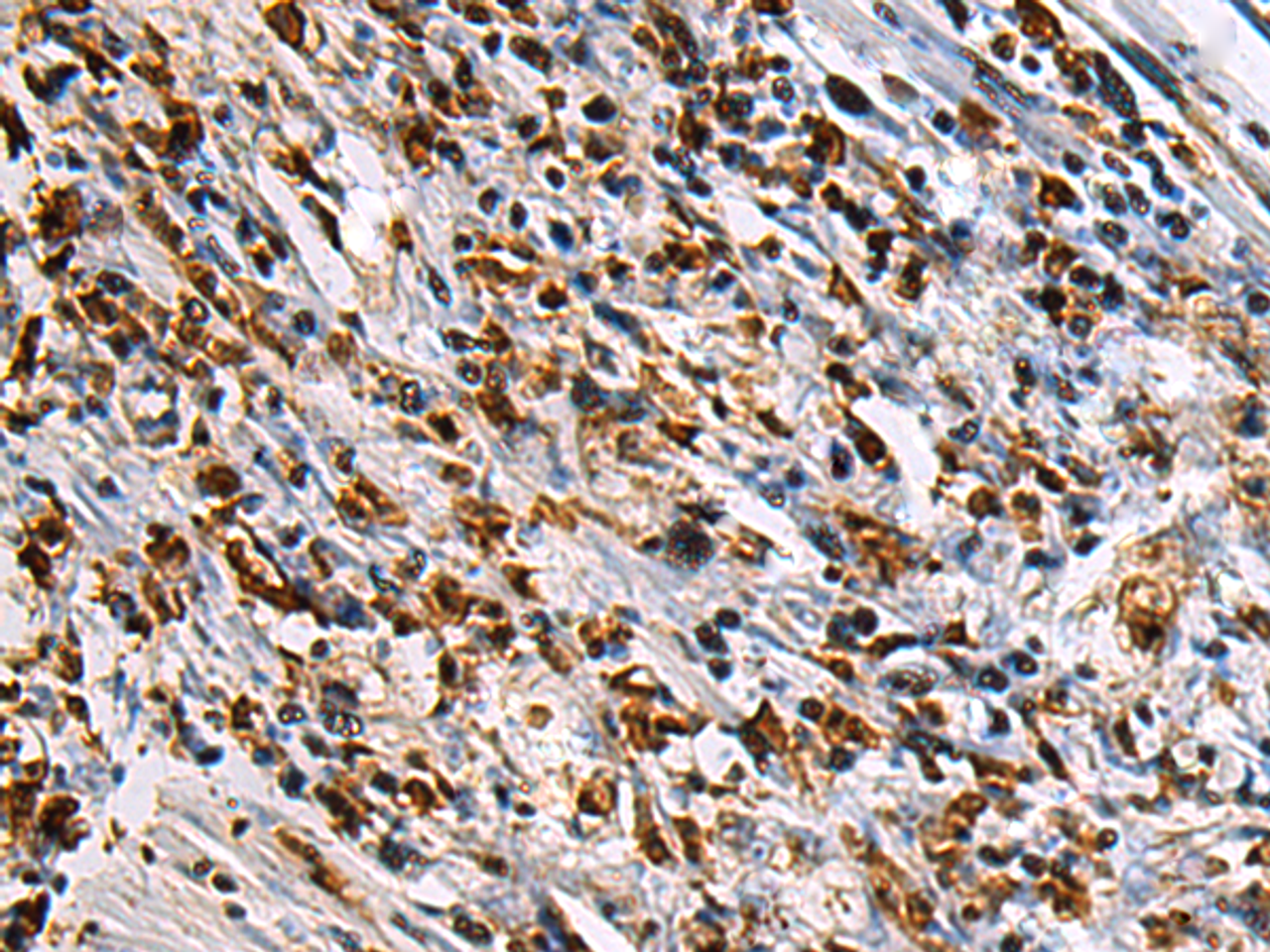 Immunohistochemistry of paraffin-embedded Human gastric cancer tissue  using SAV1 Polyclonal Antibody at dilution of 1:90(×200)