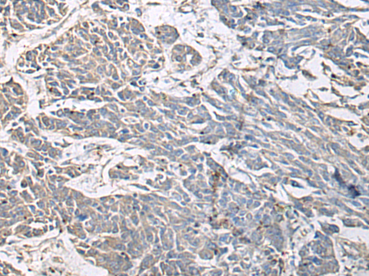Immunohistochemistry of paraffin-embedded Human colorectal cancer tissue  using PRKCSH Polyclonal Antibody at dilution of 1:65(×200)