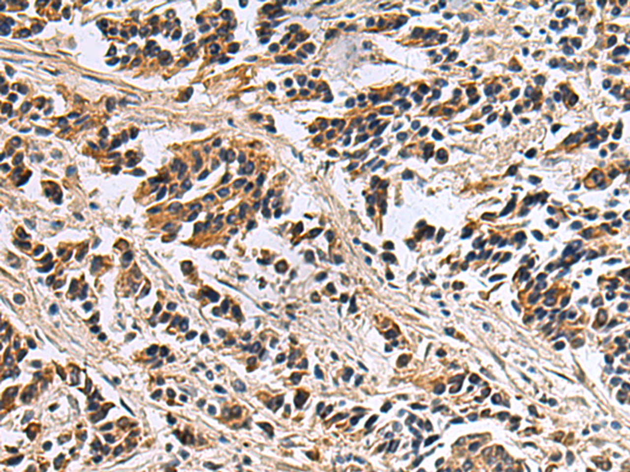 Immunohistochemistry of paraffin-embedded Human breast cancer tissue  using DIAPH2 Polyclonal Antibody at dilution of 1:55(×200)