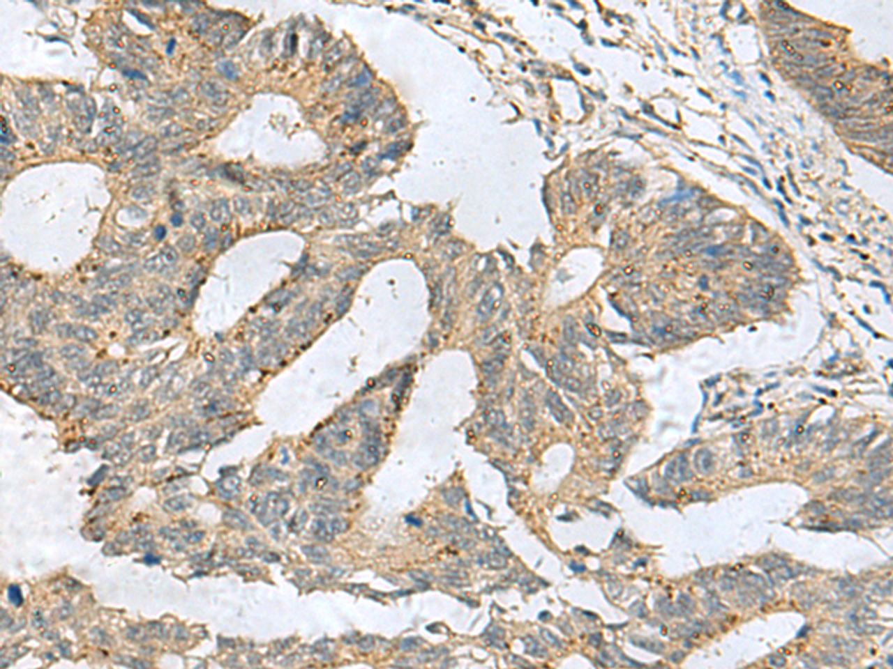 Immunohistochemistry of paraffin-embedded Human colorectal cancer tissue  using CXCR5 Polyclonal Antibody at dilution of 1:80(×200)