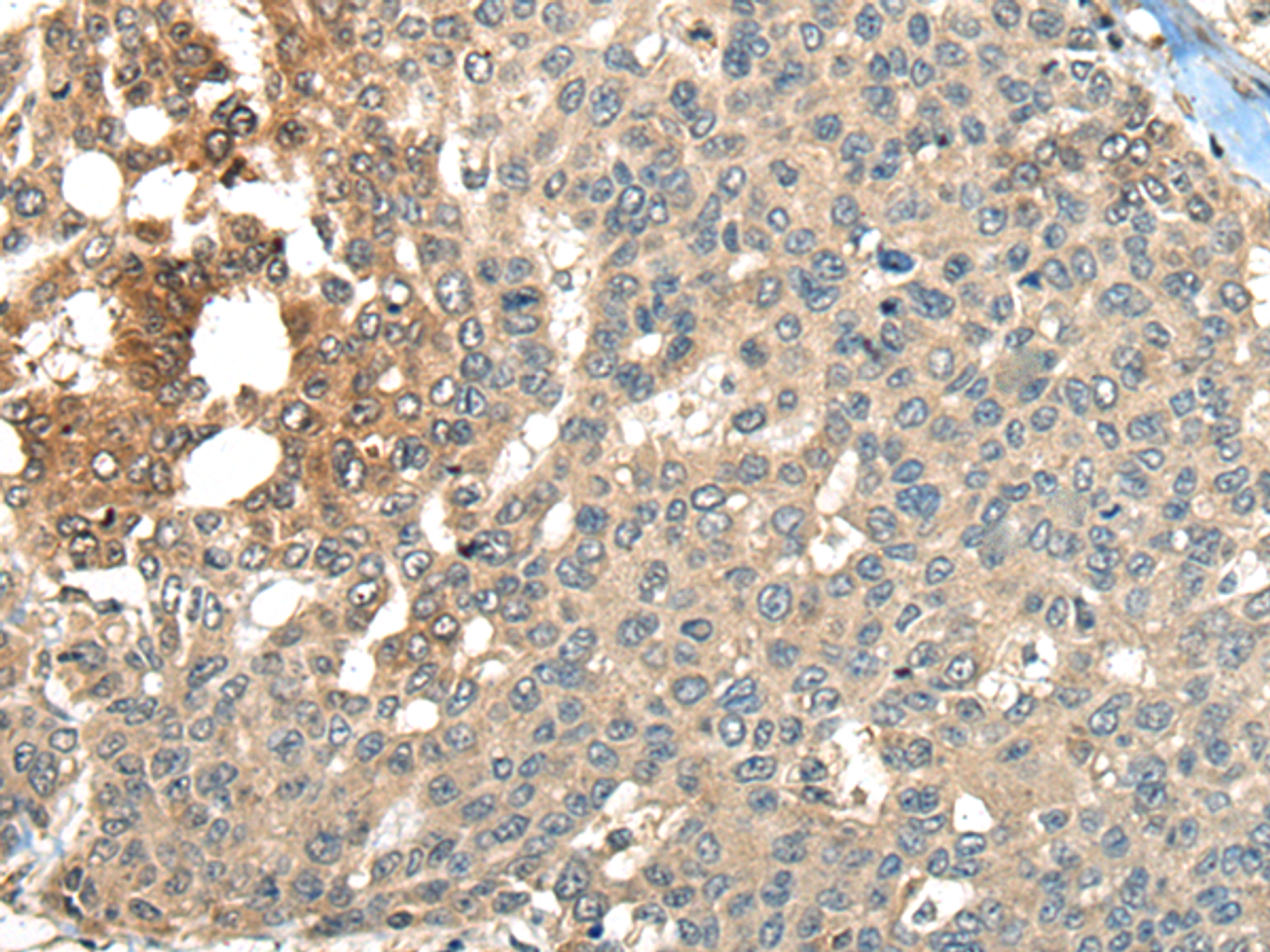 Immunohistochemistry of paraffin-embedded Human liver cancer tissue  using MAPK4 Polyclonal Antibody at dilution of 1:35(×200)