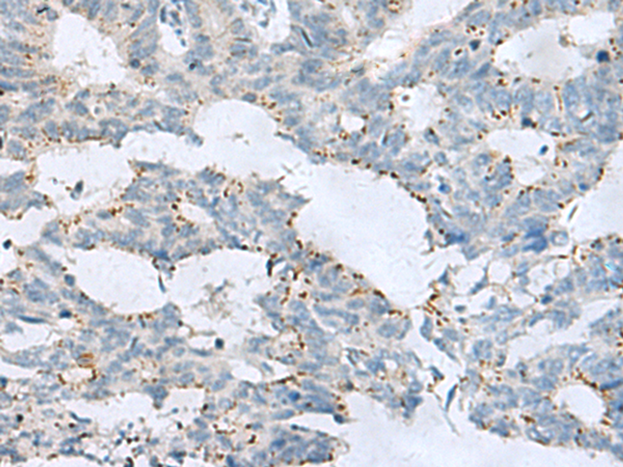 Immunohistochemistry of paraffin-embedded Human colorectal cancer tissue  using GPR6  Polyclonal Antibody at dilution of 1:80(×200)