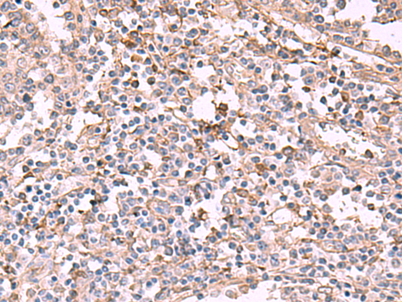 Immunohistochemistry of paraffin-embedded Human tonsil tissue  using ADH1B Polyclonal Antibody at dilution of 1:55(×200)