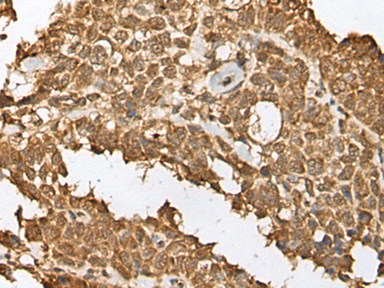 Immunohistochemistry of paraffin-embedded Human ovarian cancer tissue  using RBL2 Polyclonal Antibody at dilution of 1:45(×200)