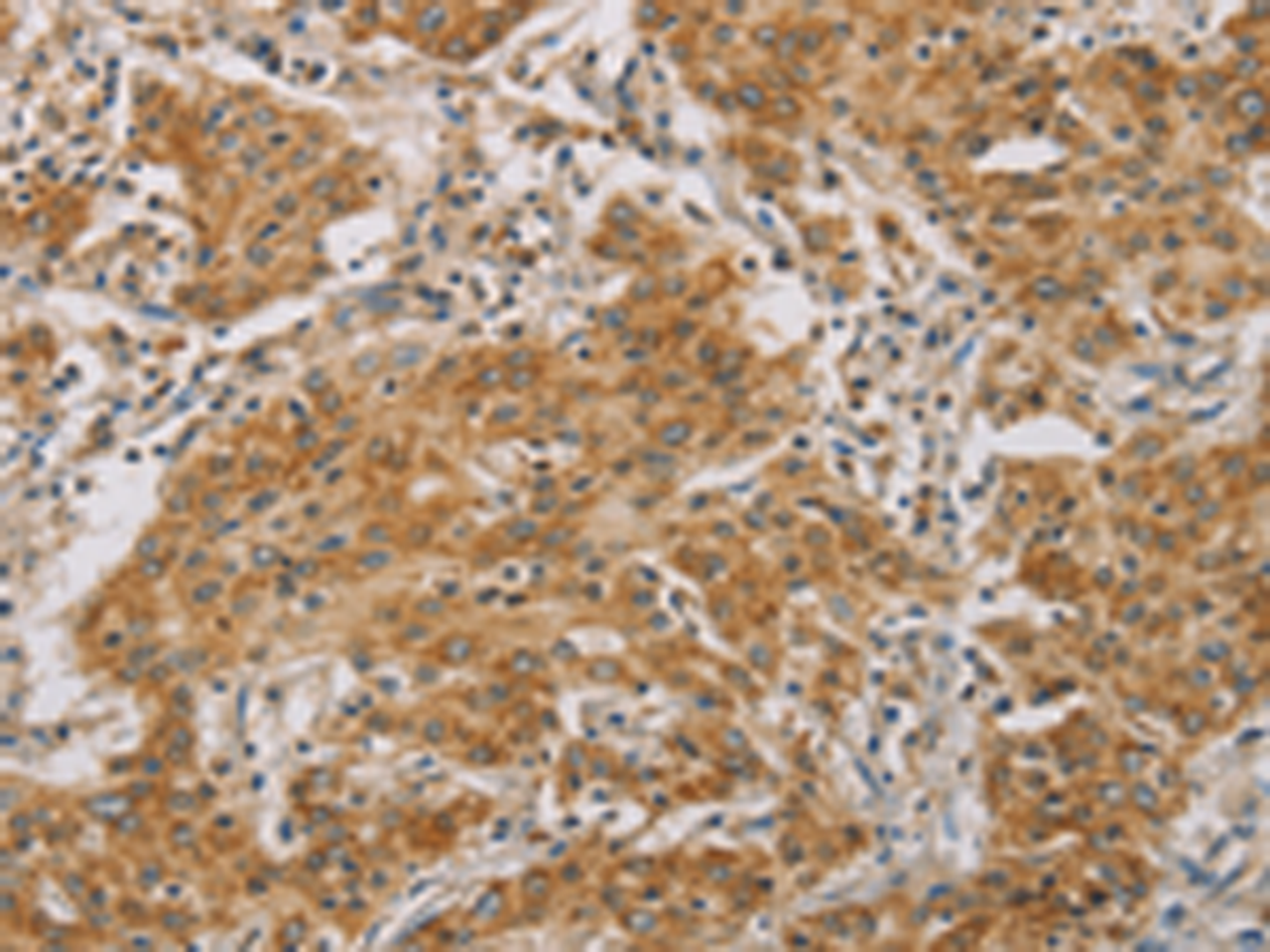 Immunohistochemistry of paraffin-embedded Human gasrtic cancer tissue  using CDKN2A Polyclonal Antibody at dilution of 1:50(×200)