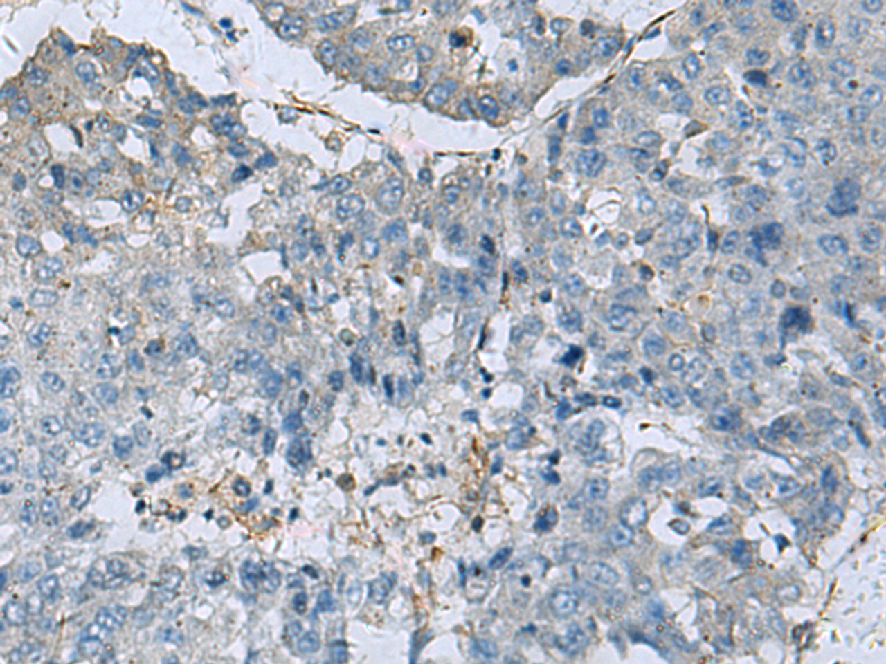 Immunohistochemistry of paraffin-embedded Human liver cancer tissue  using GLS Polyclonal Antibody at dilution of 1:70(×200)