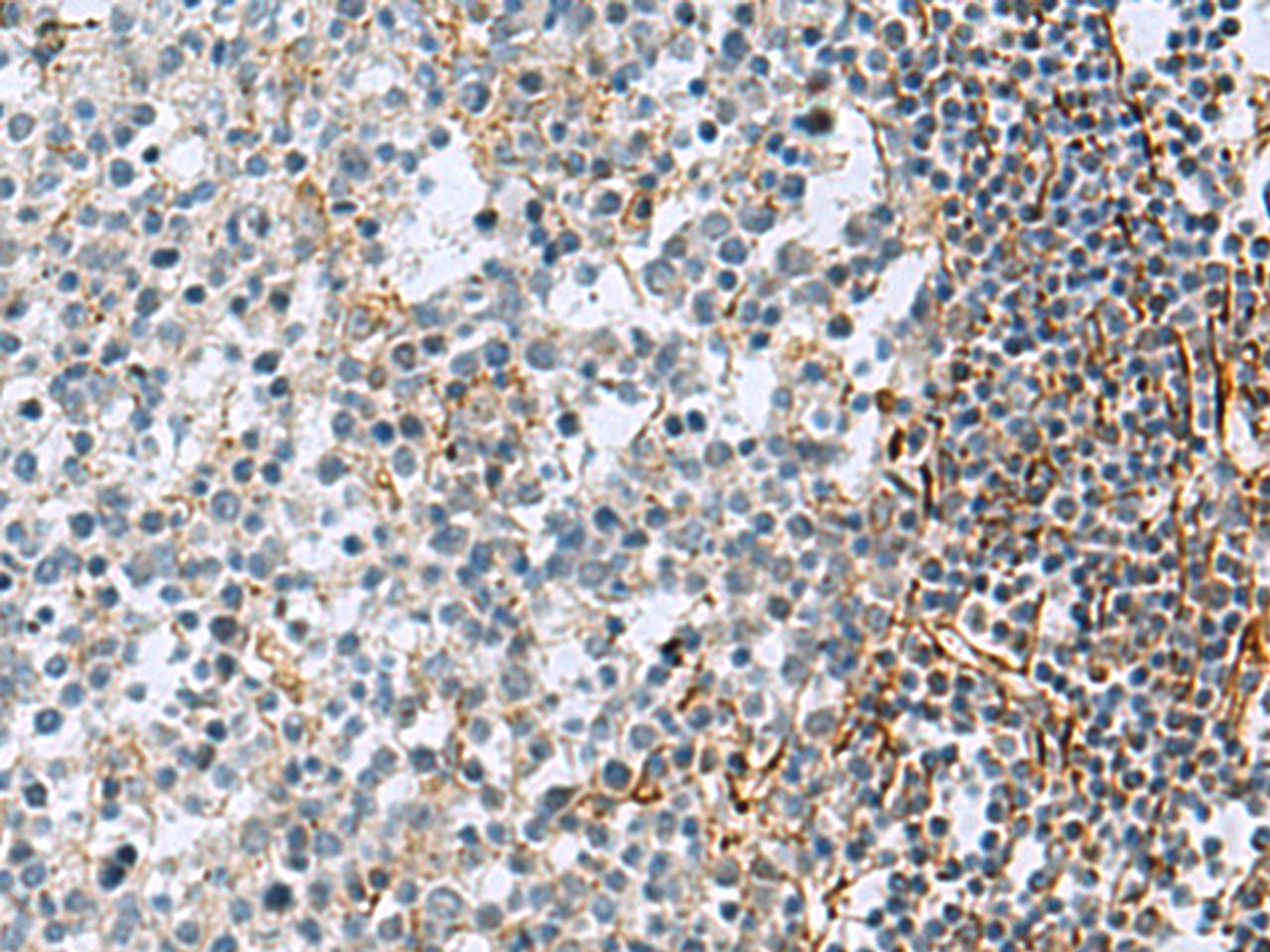 Immunohistochemistry of paraffin-embedded Human tonsil tissue  using GLS Polyclonal Antibody at dilution of 1:70(×200)