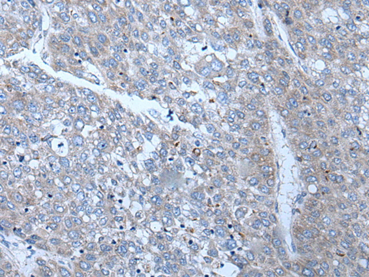 Immunohistochemistry of paraffin-embedded Human liver cancer tissue  using SLC24A5 Polyclonal Antibody at dilution of 1:50(×200)