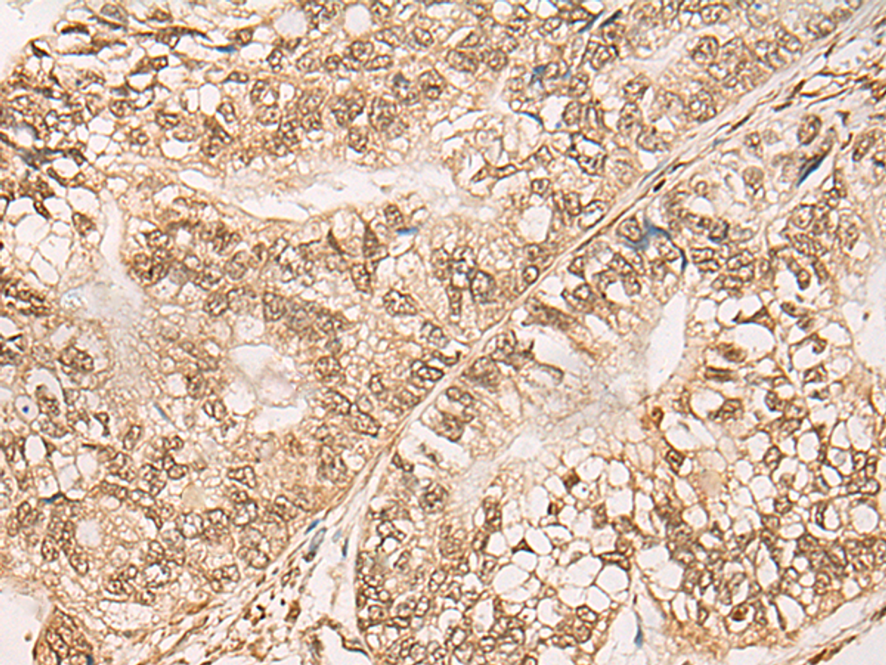 Immunohistochemistry of paraffin-embedded Human gastric cancer tissue  using WEE1 Polyclonal Antibody at dilution of 1:35(×200)