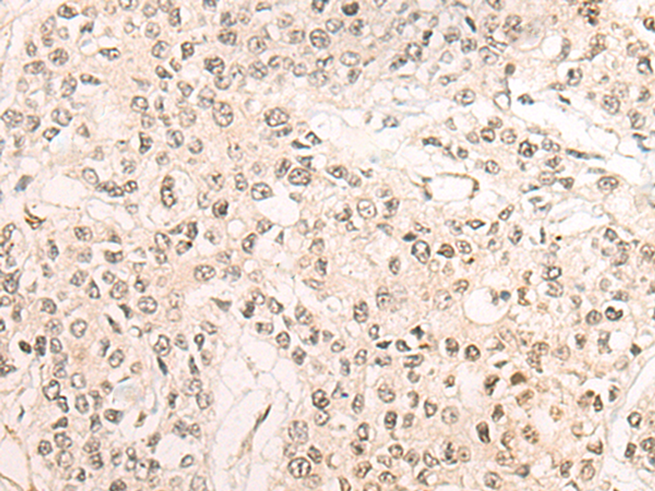 Immunohistochemistry of paraffin-embedded Human prost ate cancer tissue  using WEE1 Polyclonal Antibody at dilution of 1:35(×200)