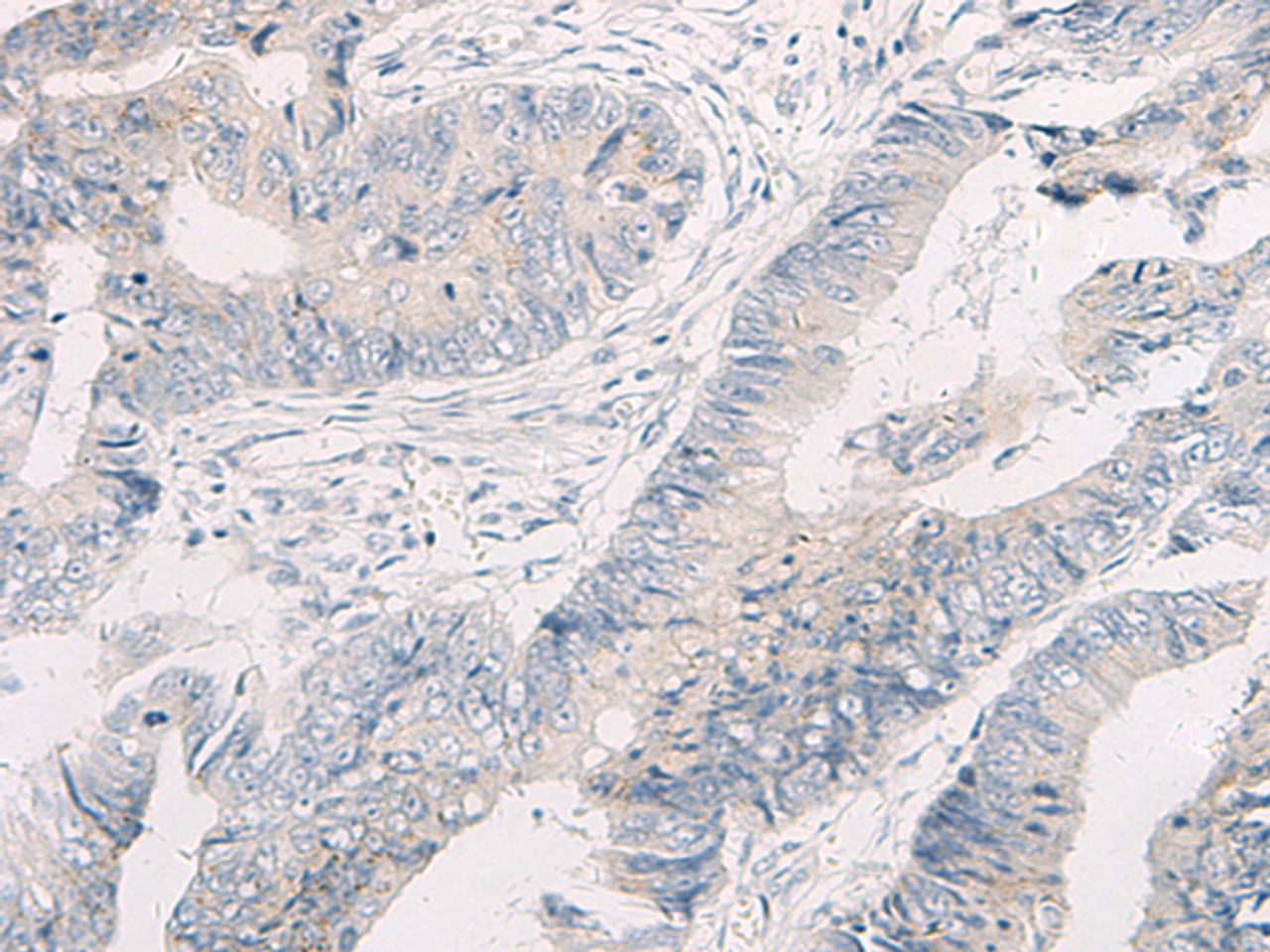 Immunohistochemistry of paraffin-embedded Human colorectal cancer tissue  using WNK4 Polyclonal Antibody at dilution of 1:45(×200)