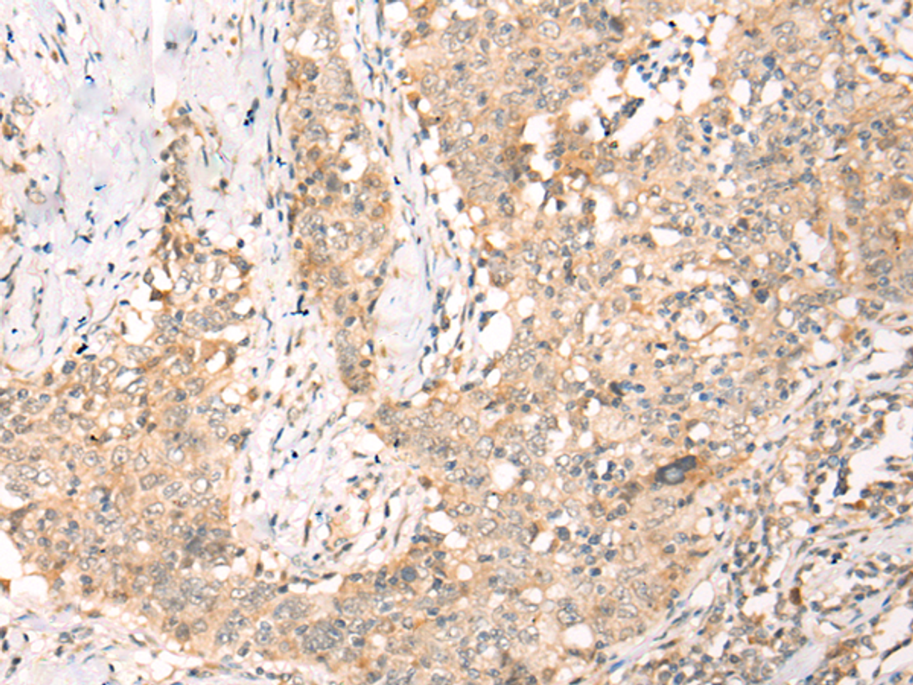 Immunohistochemistry of paraffin-embedded Human esophagus cancer tissue  using YRDC Polyclonal Antibody at dilution of 1:30(×200)