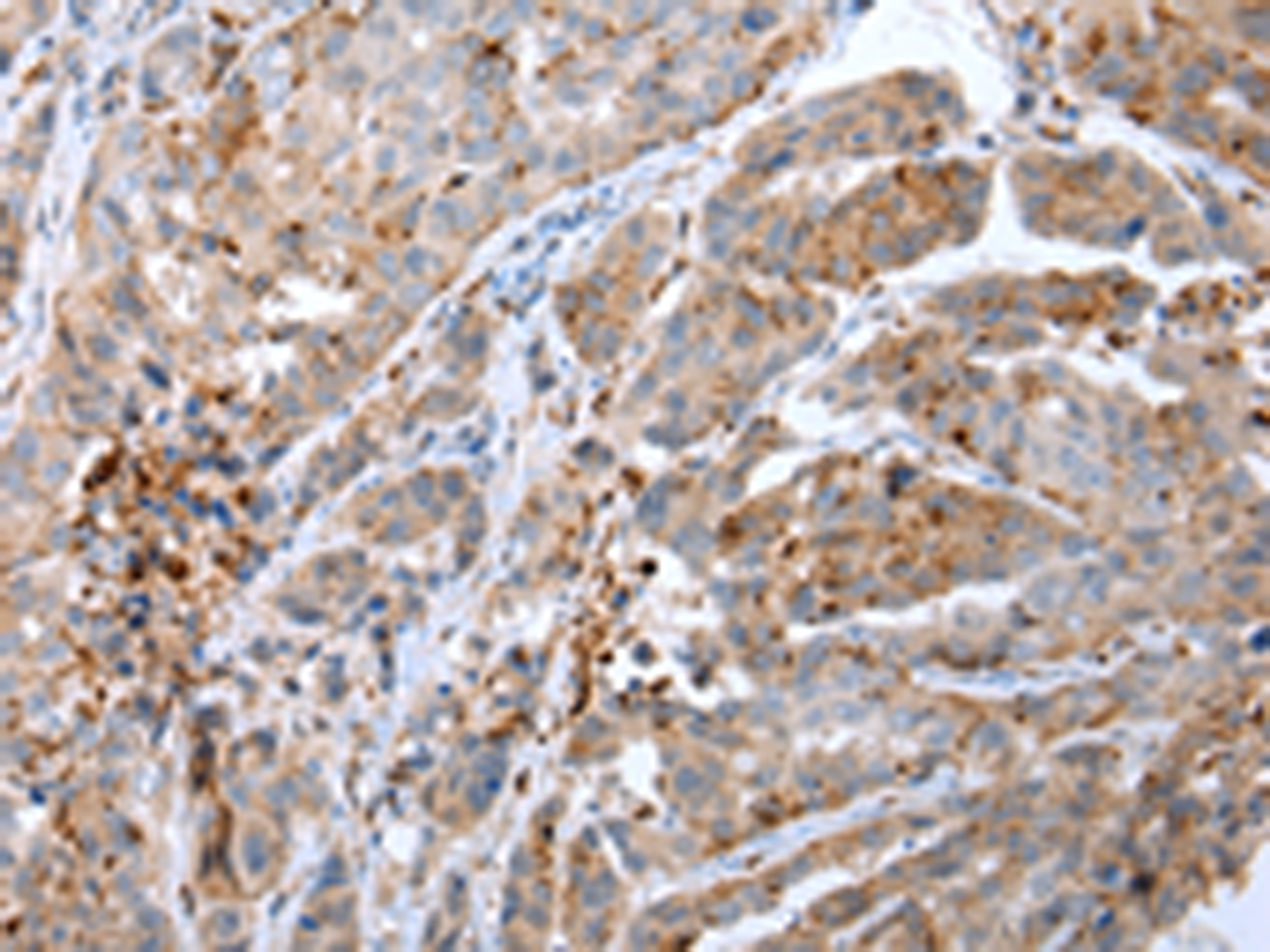 Immunohistochemistry of paraffin-embedded Human breast cancer tissue  using CALB2 Polyclonal Antibody at dilution of 1:25(×200)