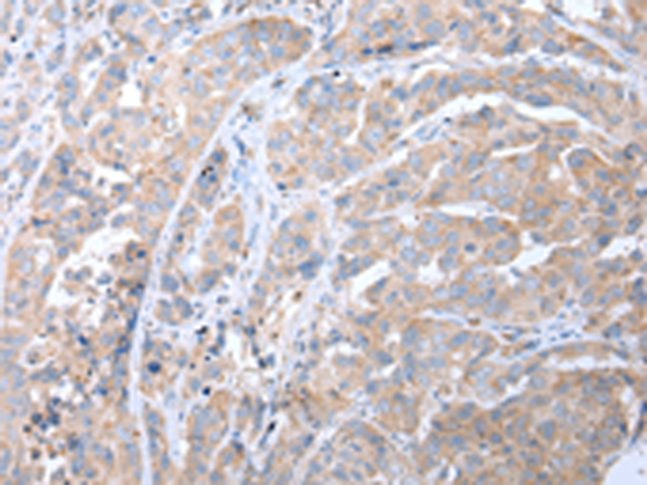 Immunohistochemistry of paraffin-embedded Human breast cancer tissue  using ATG16L1 Polyclonal Antibody at dilution of 1:40(×200)