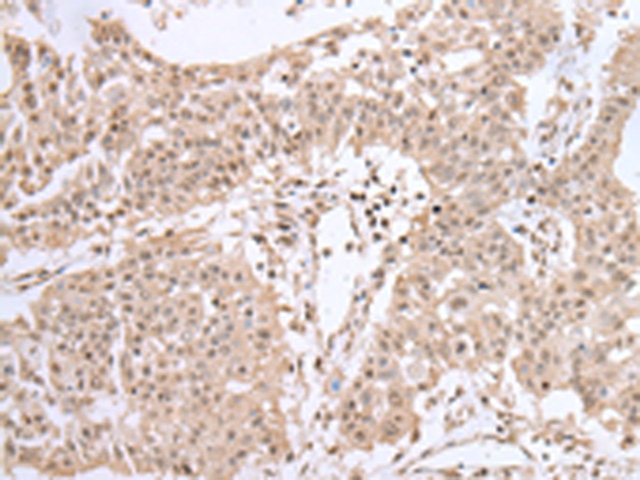 Immunohistochemistry of paraffin-embedded Human colorectal cancer tissue  using UBE2I Polyclonal Antibody at dilution of 1:40(×200)