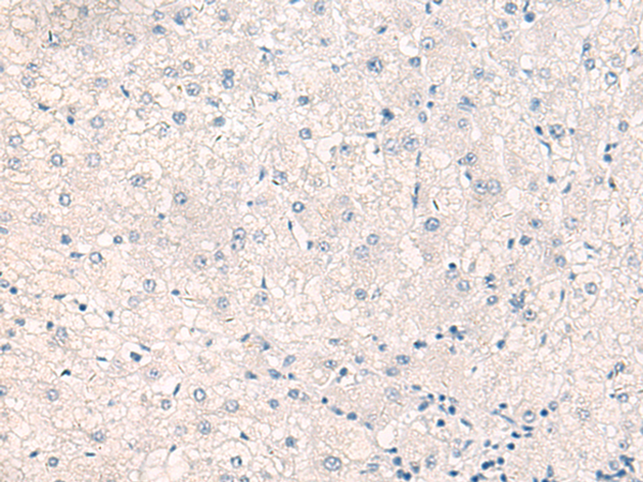 Immunohistochemistry of paraffin-embedded Human liver cancer tissue  using CEBPB  Polyclonal Antibody at dilution of 1:30(×200)