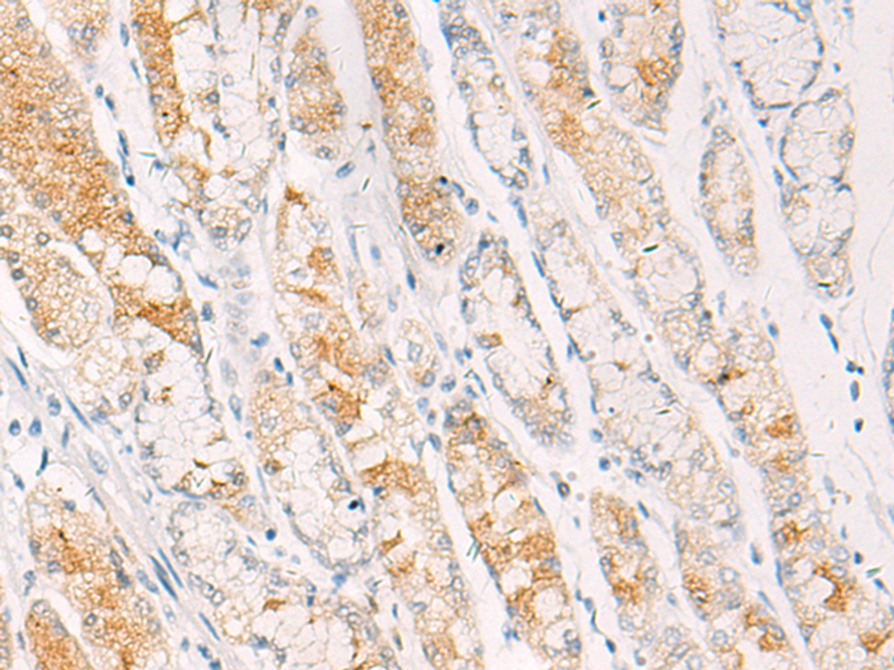 Immunohistochemistry of paraffin-embedded Human gastric cancer tissue  using CEBPB  Polyclonal Antibody at dilution of 1:30(×200)