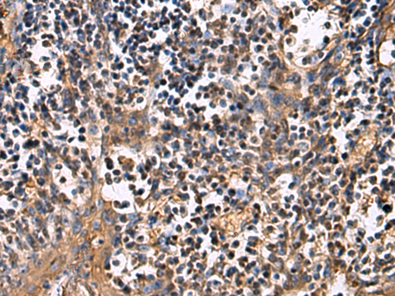 Immunohistochemistry of paraffin-embedded Human tonsil tissue  using ECM1 Polyclonal Antibody at dilution of 1:25(×200)