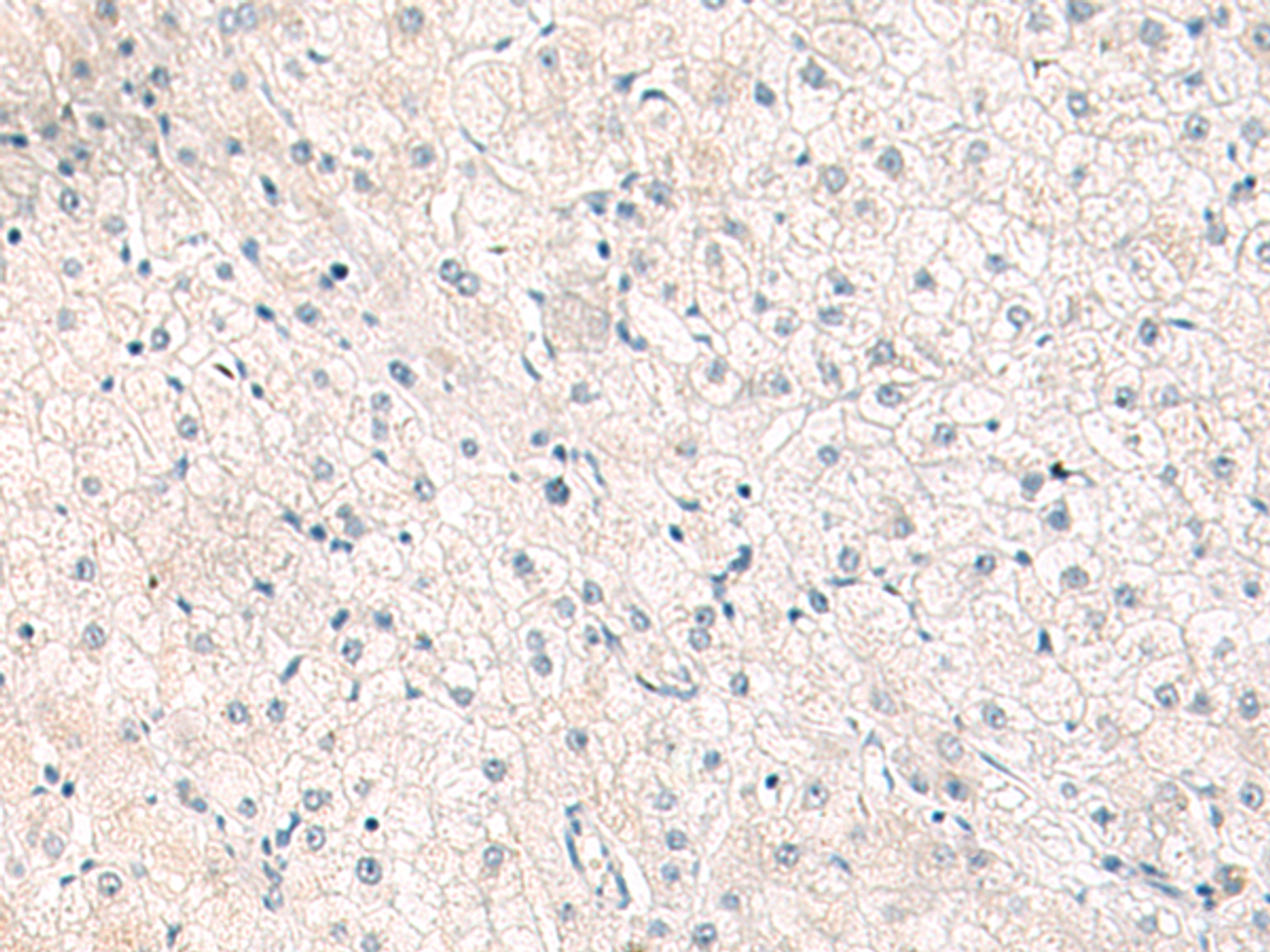 Immunohistochemistry of paraffin-embedded Human liver cancer tissue  using FGFR4 Polyclonal Antibody at dilution of 1:25(×200)