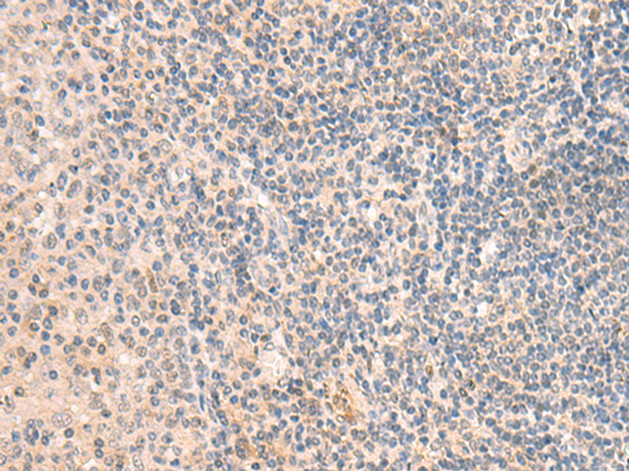 Immunohistochemistry of paraffin-embedded Human tonsil tissue  using GRM2 Polyclonal Antibody at dilution of 1:50(×200)