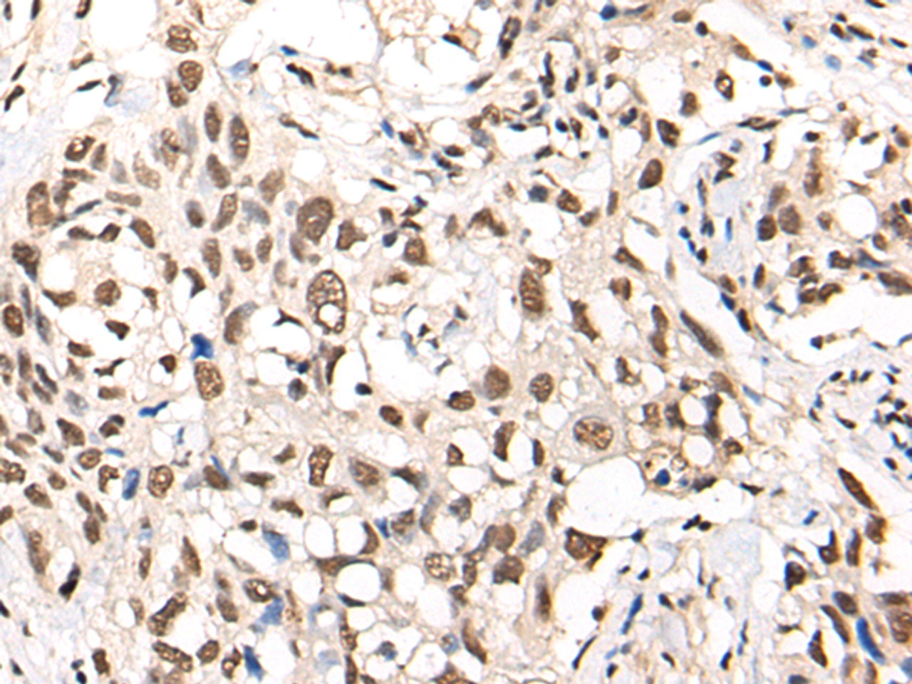 Immunohistochemistry of paraffin-embedded Human lung cancer tissue  using MTA2 Polyclonal Antibody at dilution of 1:40(×200)