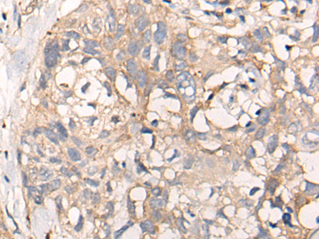 Immunohistochemistry of paraffin-embedded Human lung cancer tissue  using NREP Polyclonal Antibody at dilution of 1:35(×200)