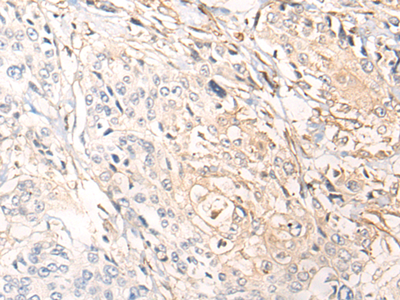 Immunohistochemistry of paraffin-embedded Human prost ate cancer tissue  using NREP Polyclonal Antibody at dilution of 1:35(×200)
