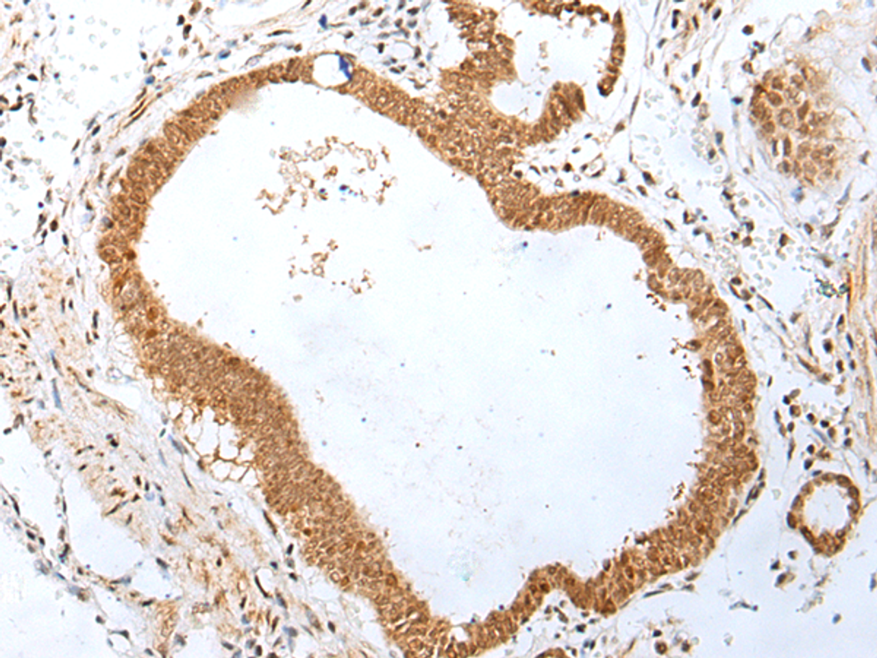 Immunohistochemistry of paraffin-embedded Human gastric cancer tissue  using PEG3 Polyclonal Antibody at dilution of 1:45(×200)