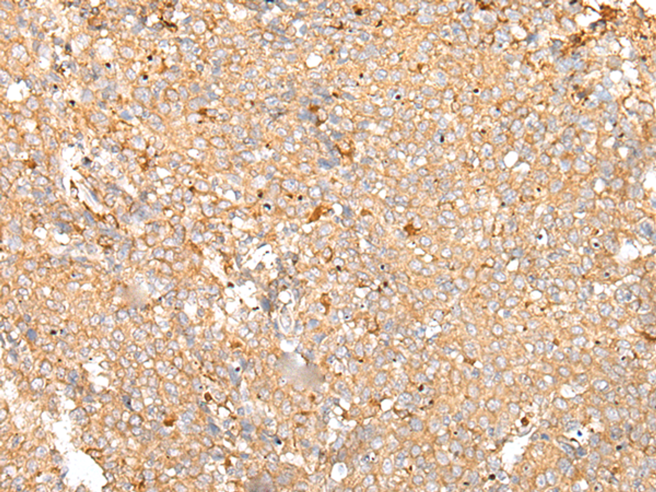 Immunohistochemistry of paraffin-embedded Human cervical cancer tissue  using PRDX4 Polyclonal Antibody at dilution of 1:25(×200)
