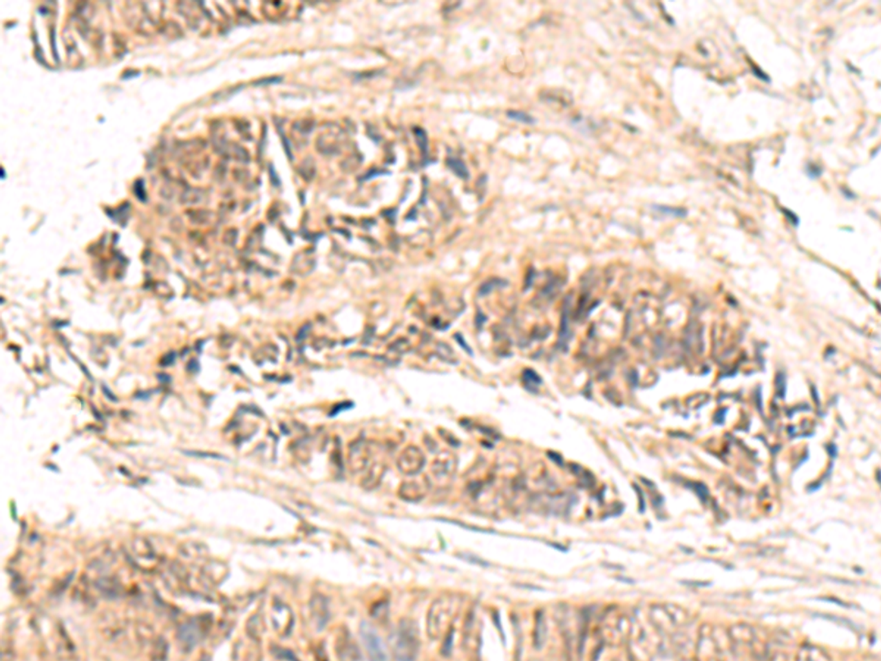 Immunohistochemistry of paraffin-embedded Human colorectal cancer tissue  using ABCB4 Polyclonal Antibody at dilution of 1:70(×200)