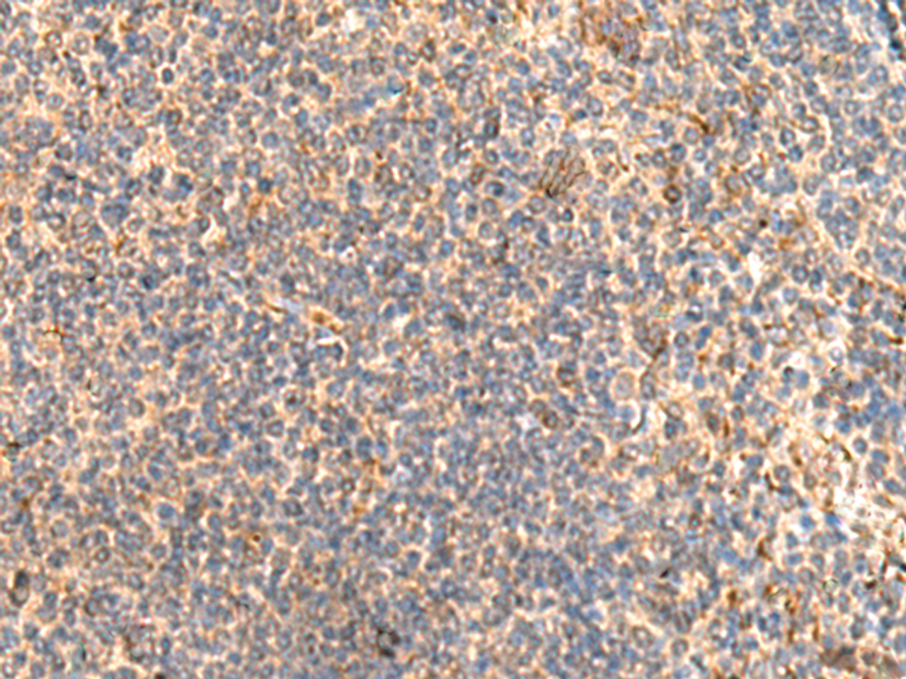 Immunohistochemistry of paraffin-embedded Human tonsil tissue  using ABHD2 Polyclonal Antibody at dilution of 1:40(×200)