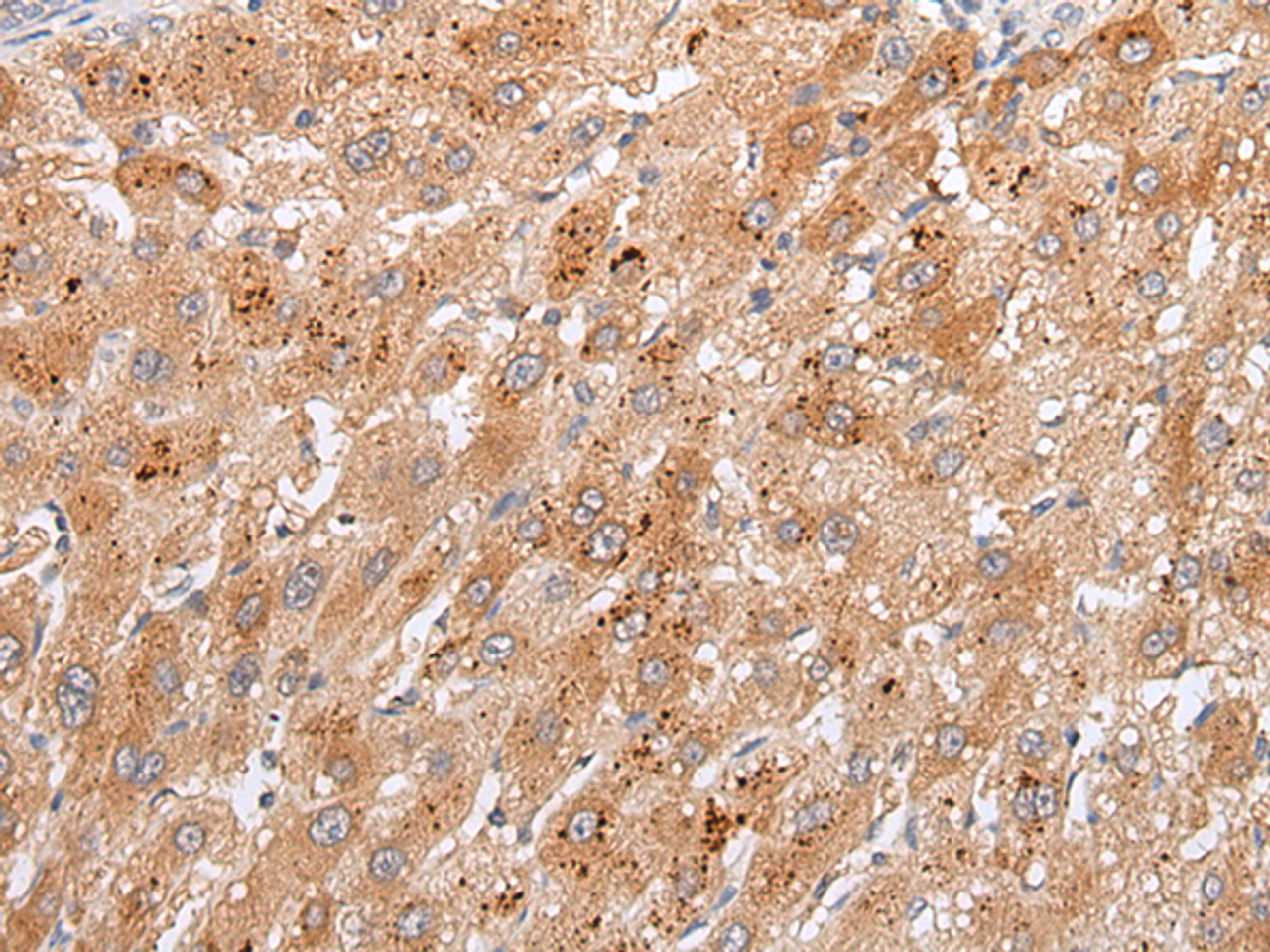 Immunohistochemistry of paraffin-embedded Human liver cancer tissue  using GPC4 Polyclonal Antibody at dilution of 1:30(×200)