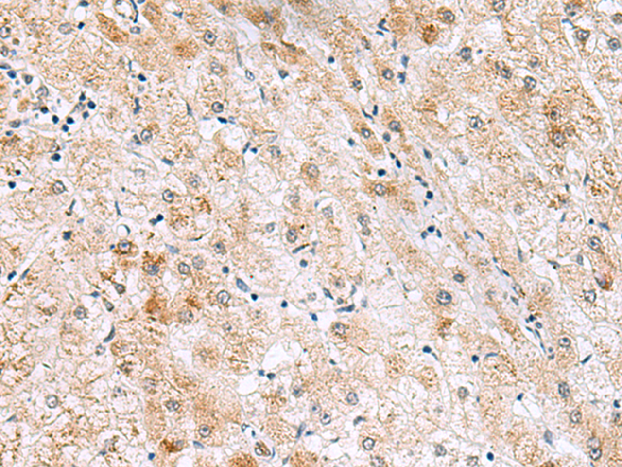 Immunohistochemistry of paraffin-embedded Human liver cancer tissue  using GPC2 Polyclonal Antibody at dilution of 1:40(×200)