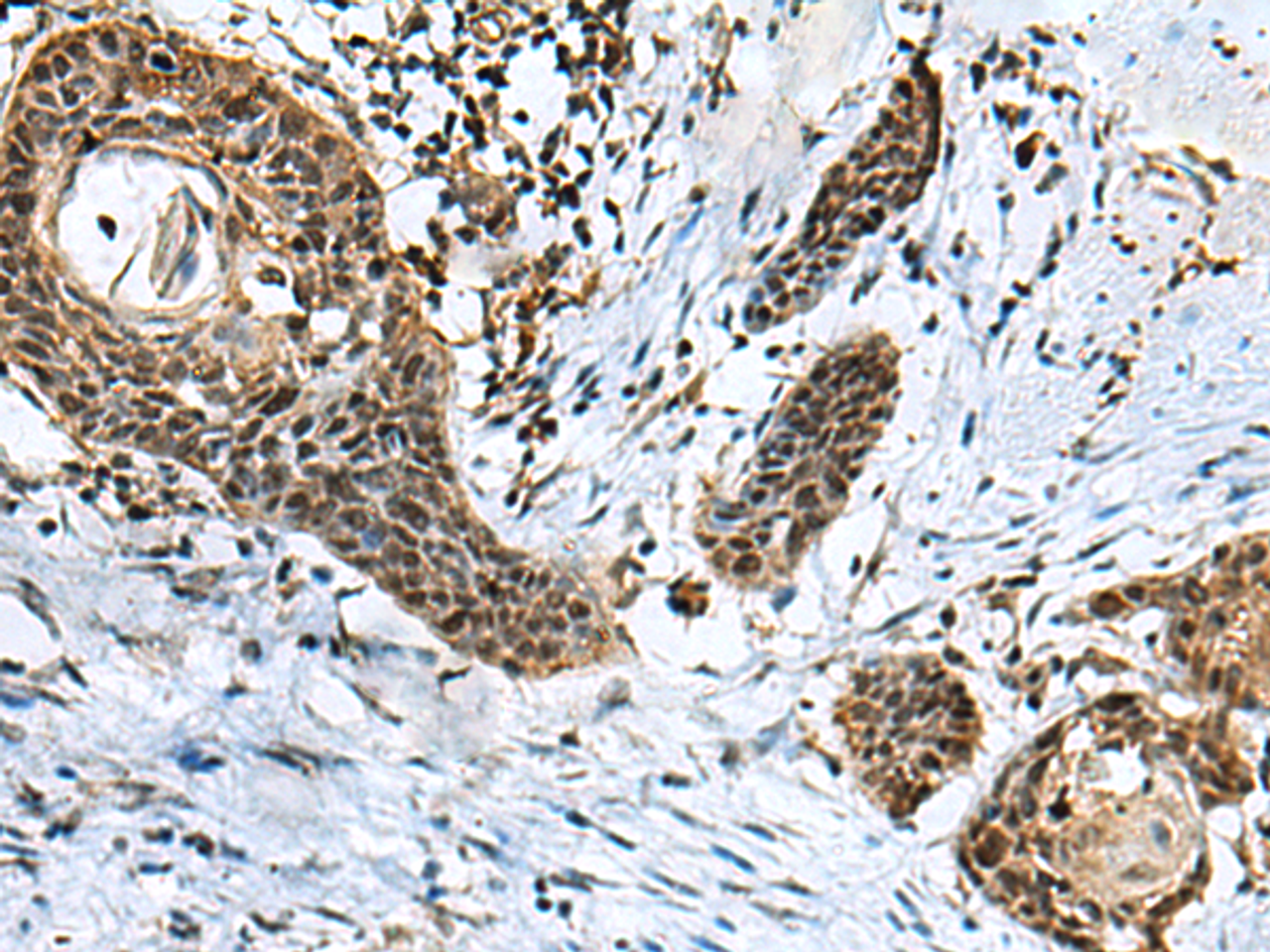 Immunohistochemistry of paraffin-embedded Human esophagus cancer tissue  using GLI1 Polyclonal Antibody at dilution of 1:40(×200)