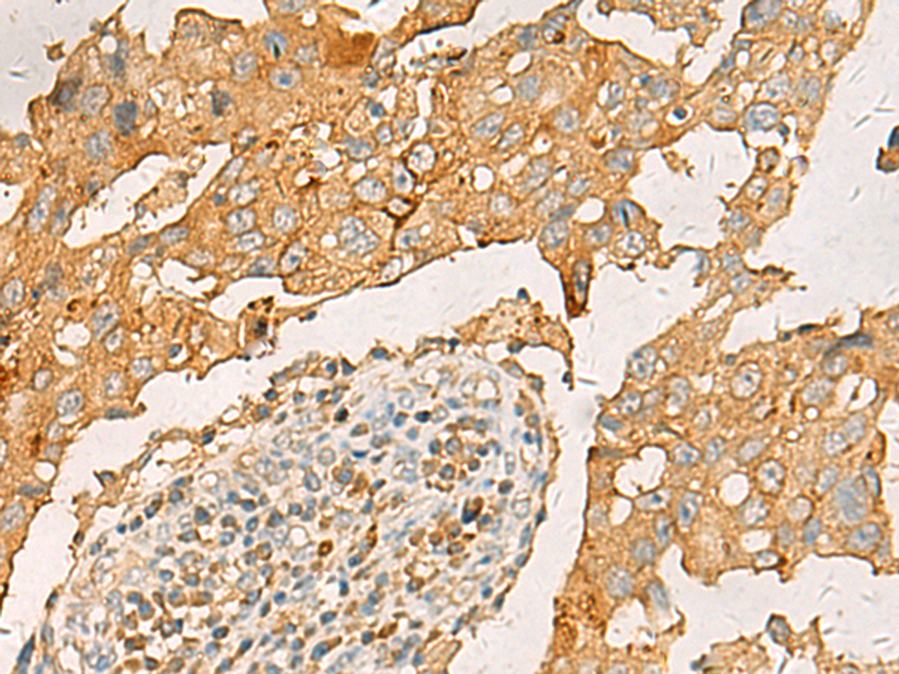 Immunohistochemistry of paraffin-embedded Human breast cancer tissue  using CXCL1 Polyclonal Antibody at dilution of 1:35(×200)