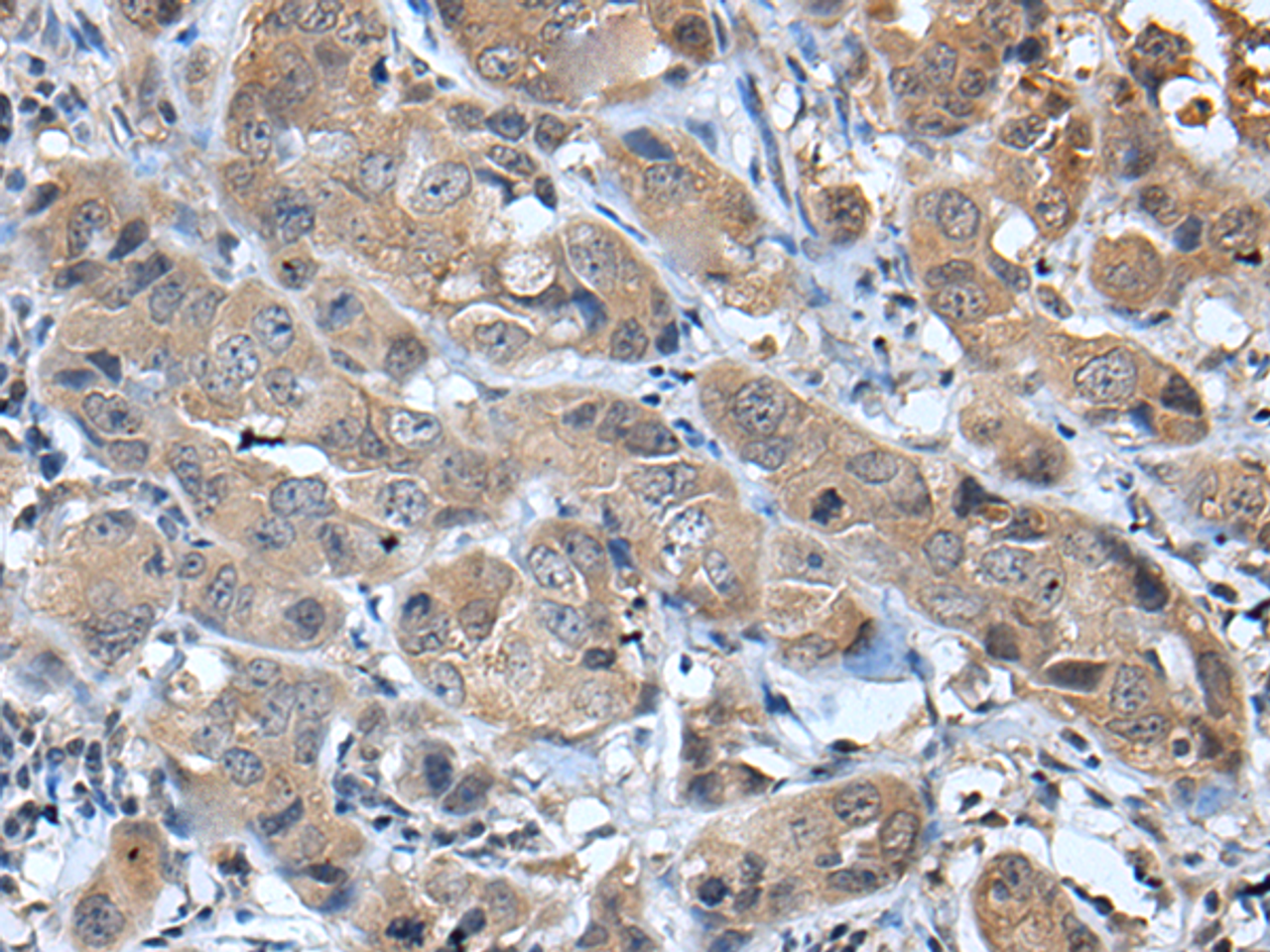 Immunohistochemistry of paraffin-embedded Human breast cancer tissue  using CXCL5 Polyclonal Antibody at dilution of 1:45(×200)