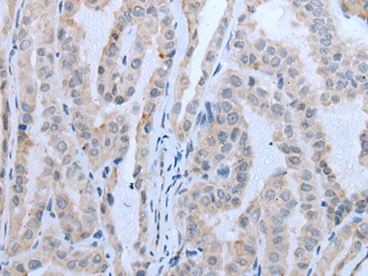 Immunohistochemistry of paraffin-embedded Human thyroid cancer tissue  using IGF2BP3 Polyclonal Antibody at dilution of 1:30(×200)