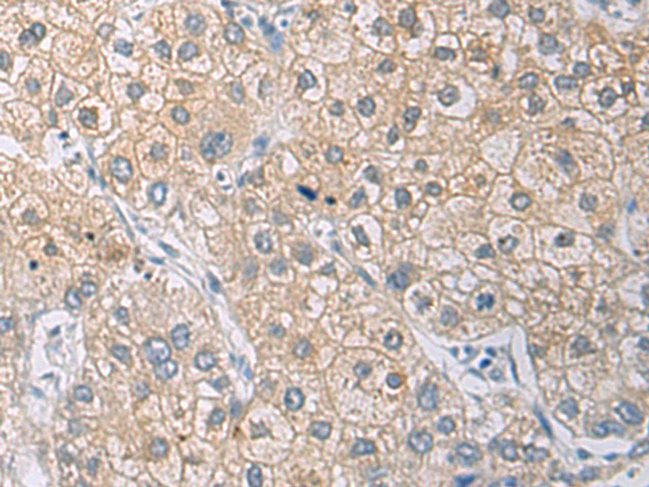 Immunohistochemistry of paraffin-embedded Human liver cancer tissue  using IL1RN Polyclonal Antibody at dilution of 1:50(×200)