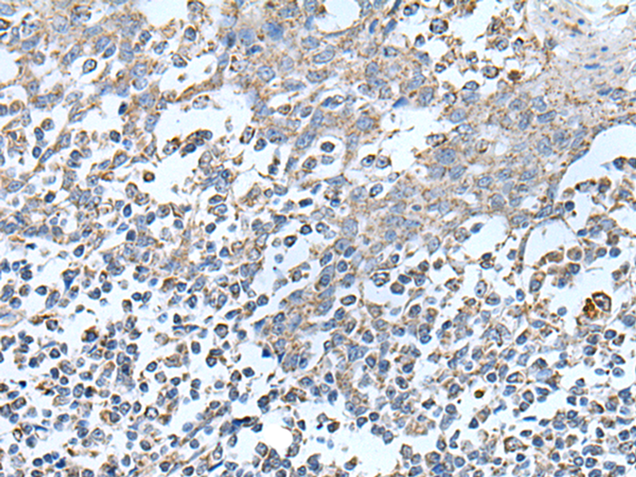 Immunohistochemistry of paraffin-embedded Human tonsil tissue  using IRF5 Polyclonal Antibody at dilution of 1:25(×200)