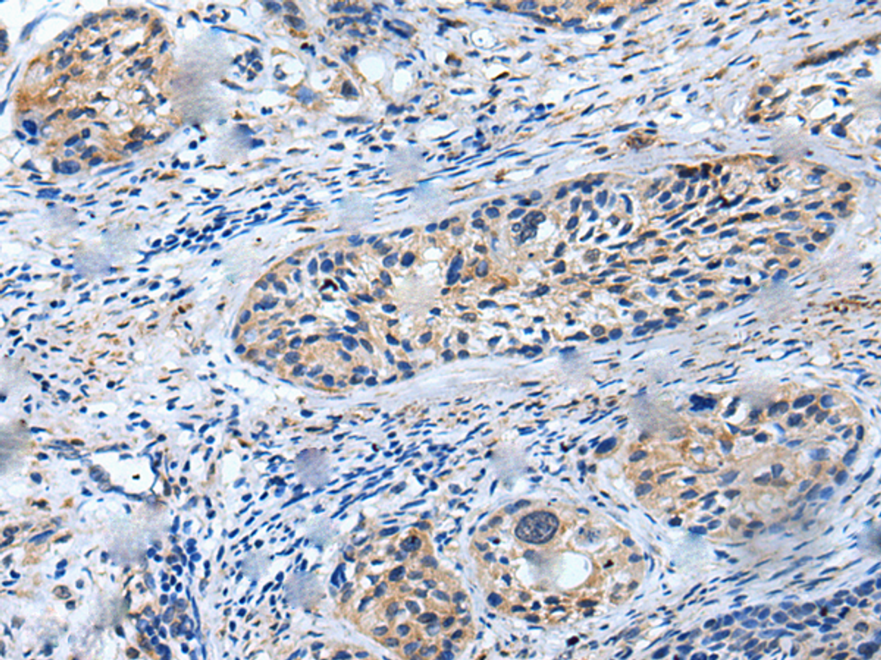 Immunohistochemistry of paraffin-embedded Human cervical cancer tissue  using LILRB5 Polyclonal Antibody at dilution of 1:25(×200)