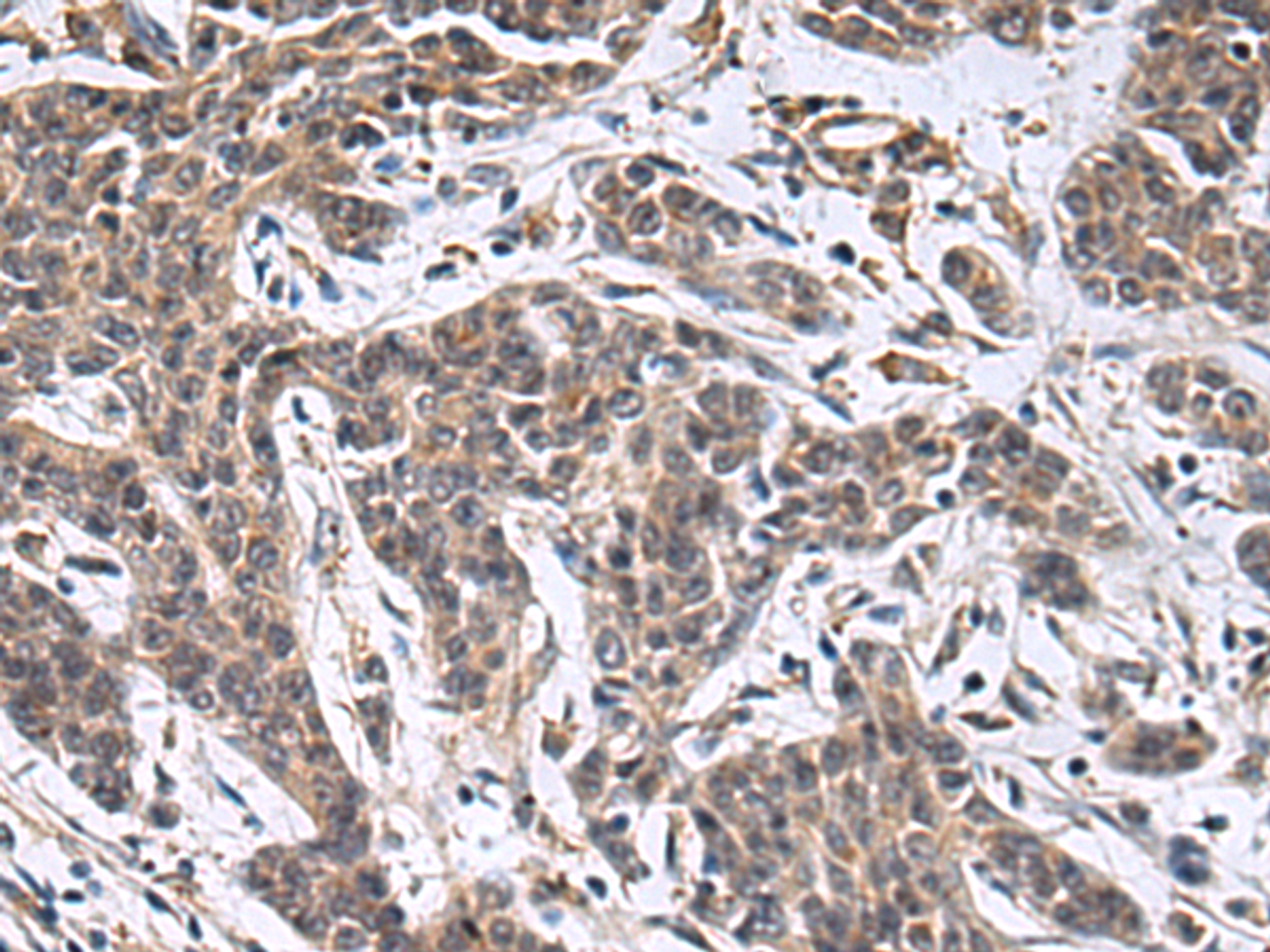 Immunohistochemistry of paraffin-embedded Human colorectal cancer tissue  using MBL2 Polyclonal Antibody at dilution of 1:25(×200)