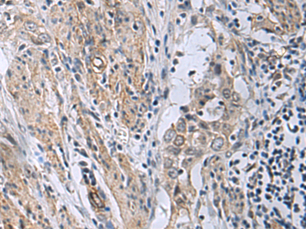 Immunohistochemistry of paraffin-embedded Human esophagus cancer tissue  using MBL2 Polyclonal Antibody at dilution of 1:25(×200)