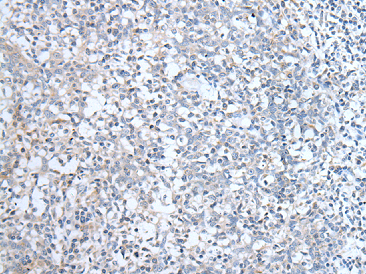 Immunohistochemistry of paraffin-embedded Human tonsil tissue  using ABCD1 Polyclonal Antibody at dilution of 1:80(×200)
