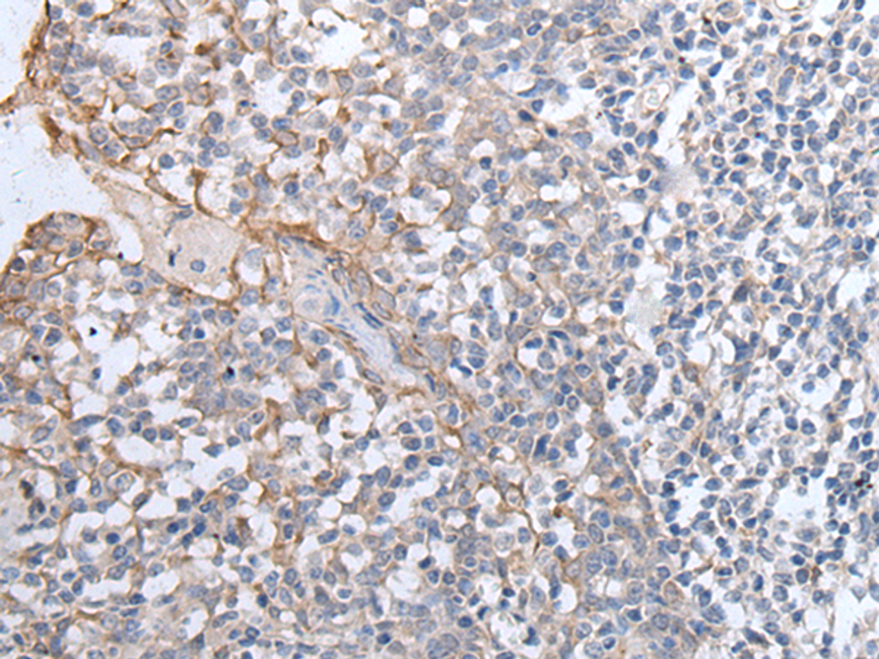 Immunohistochemistry of paraffin-embedded Human tonsil tissue  using GPD2 Polyclonal Antibody at dilution of 1:40(×200)