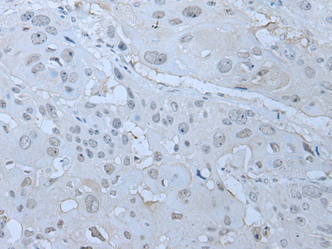 Immunohistochemistry of paraffin-embedded Human esophagus cancer tissue  using HUWE1 Polyclonal Antibody at dilution of 1:30(×200)