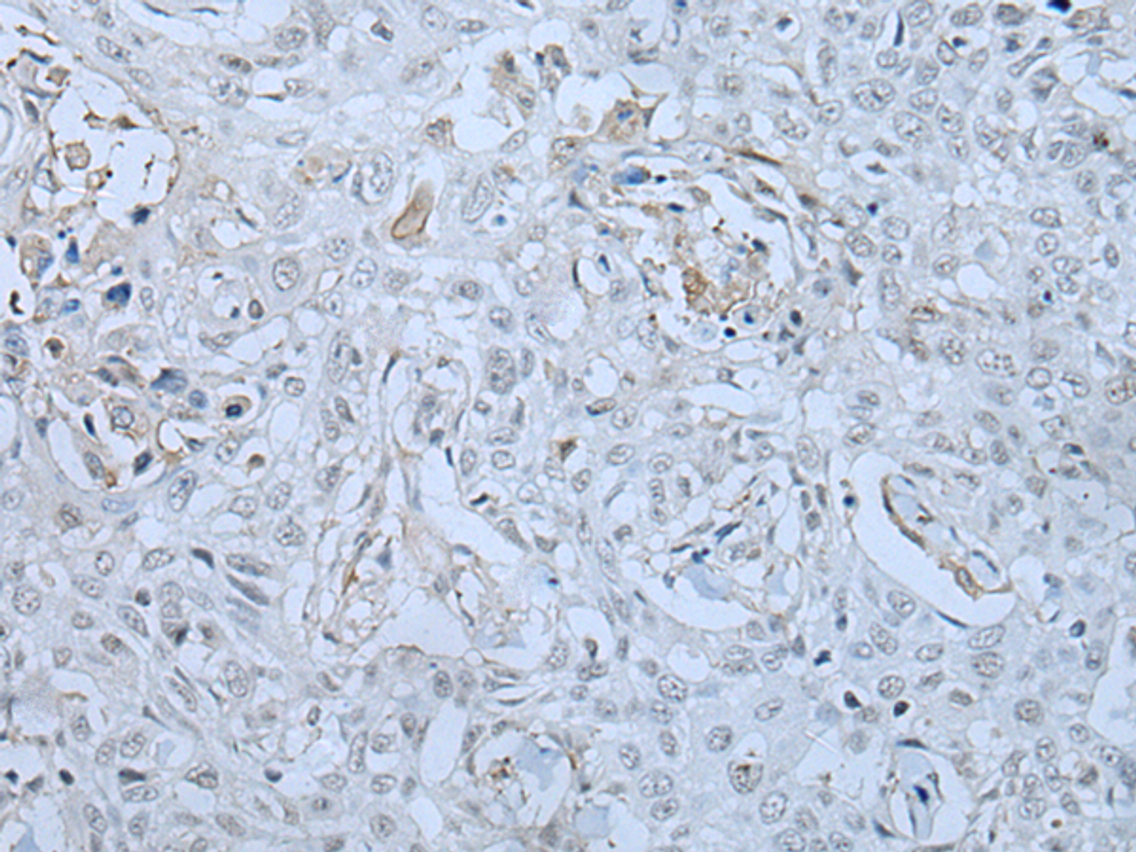 Immunohistochemistry of paraffin-embedded Human lung cancer tissue  using HUWE1 Polyclonal Antibody at dilution of 1:30(×200)