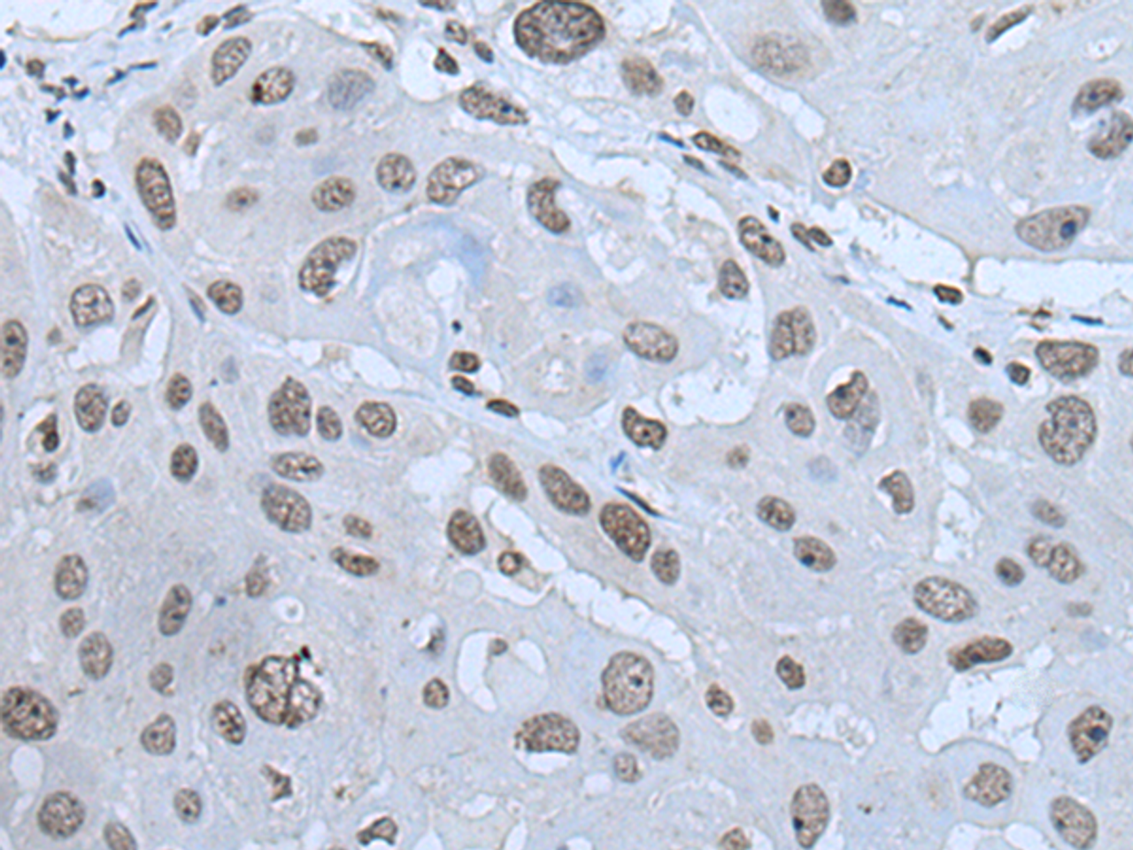 Immunohistochemistry of paraffin-embedded Human esophagus cancer tissue  using HAND1 Polyclonal Antibody at dilution of 1:30(×200)