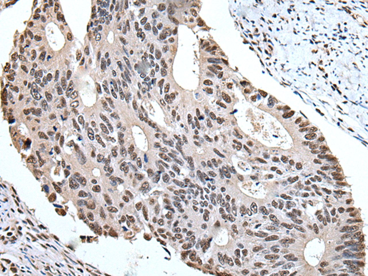 Immunohistochemistry of paraffin-embedded Human colorectal cancer tissue  using ZBTB10 Polyclonal Antibody at dilution of 1:100(×200)