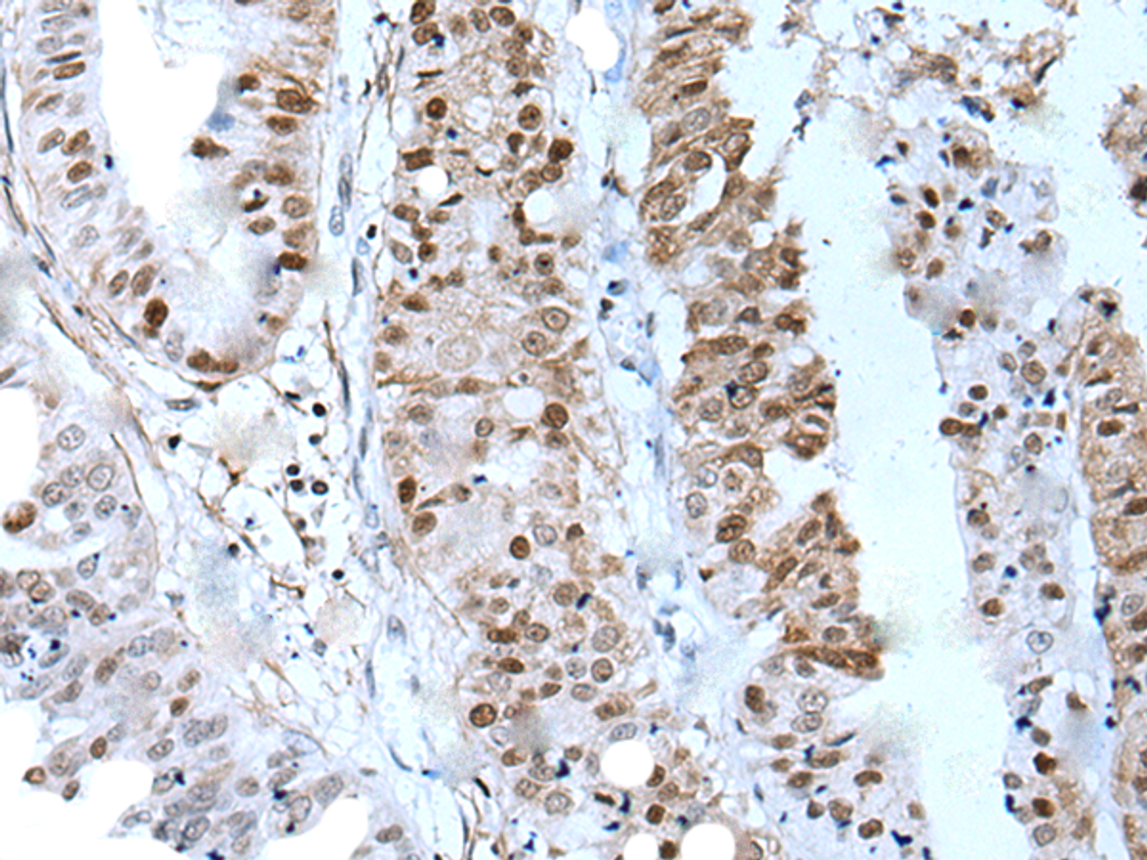 Immunohistochemistry of paraffin-embedded Human liver cancer tissue  using ZNHIT3 Polyclonal Antibody at dilution of 1:80(×200)
