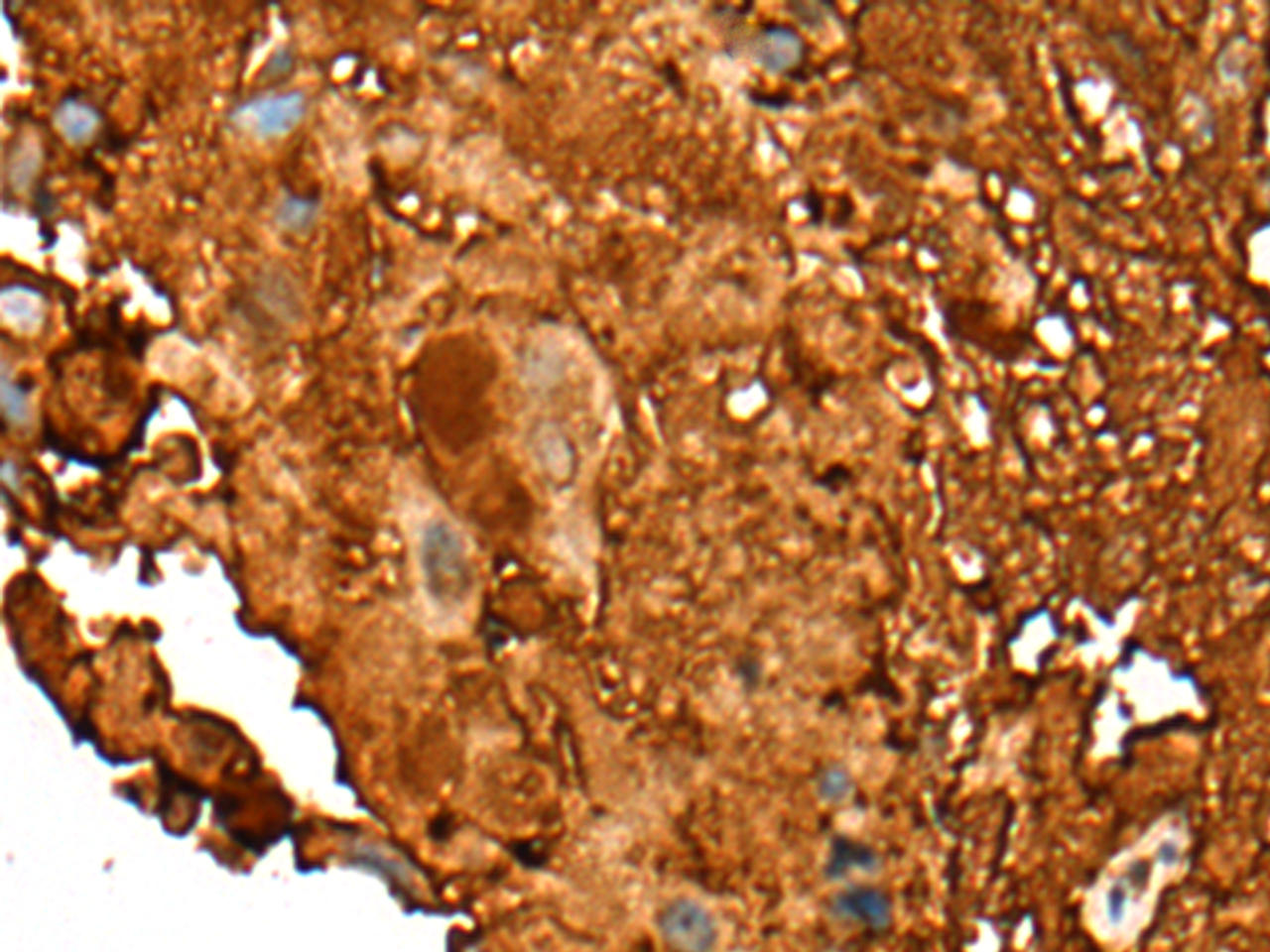 Immunohistochemistry of paraffin-embedded Human breast cancer tissue  using PEAR1 Polyclonal Antibody at dilution of 1:25(×200)